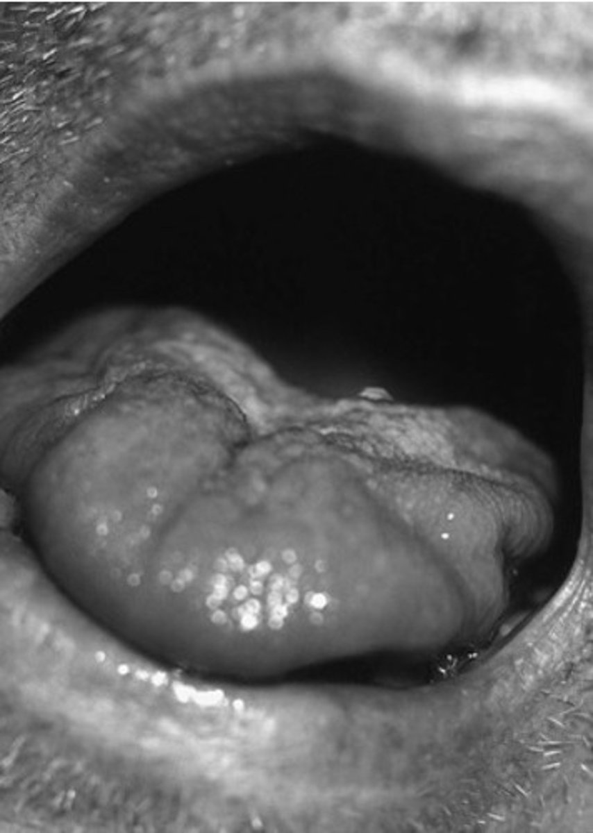 <p>Tongue atrophy</p>
