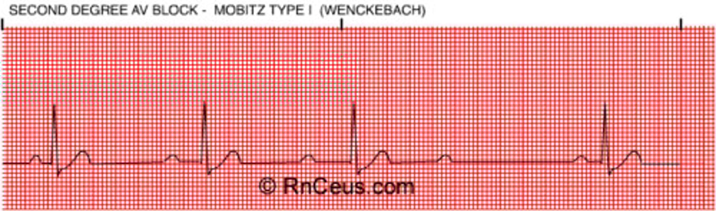 <p>"walk it back"</p><p>- PRI gradually lengthens then drops QRS "grouping and then a miss"</p><p>- typically pattern exists</p><p>(constant P-P interval, QRS is what is moving back)</p><p>- not really serious or dangerous</p>