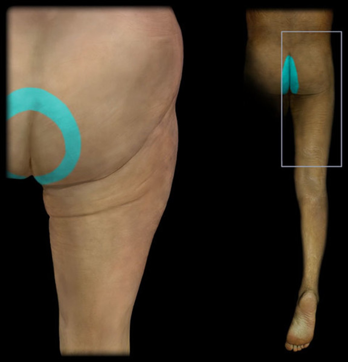 <p>Dermatome: Groin, medial thigh to knee</p>