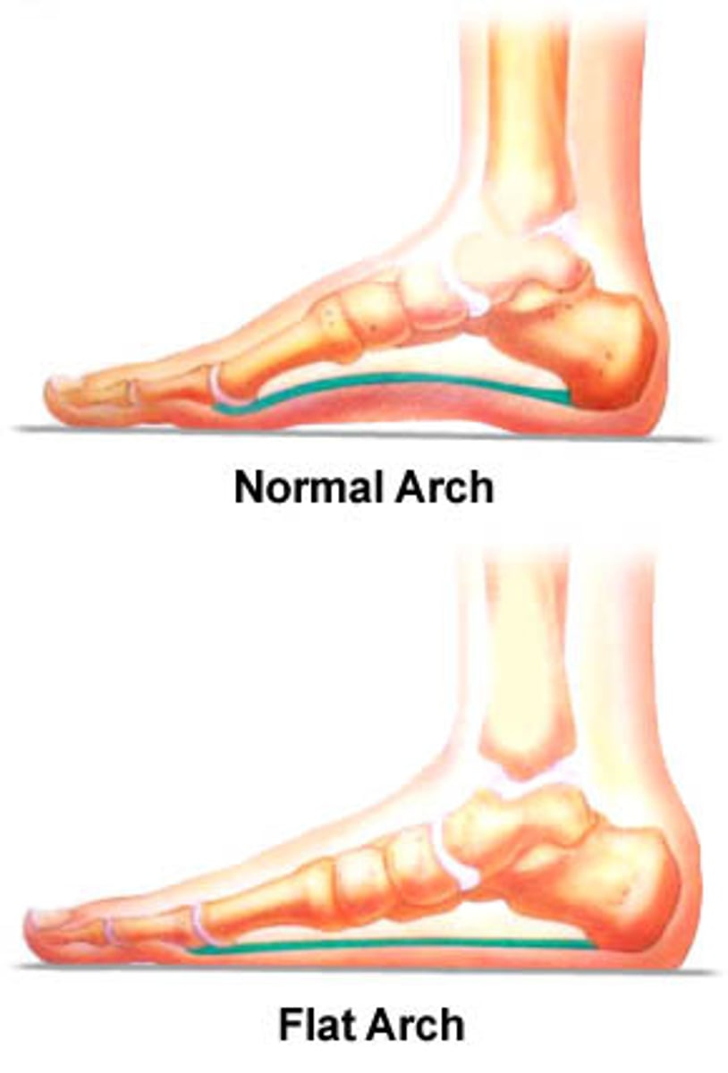 <p>Flat feet, no arch—may cause pain and swelling.</p>