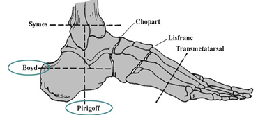 <ul><li><p><span style="color: red;">Horizontal resection of calcaneus followed by arthrodesis to distal tibia</span></p></li><li><p><span style="color: red;">Allows end weight bearing without a prosthesis</span></p></li></ul><p></p>