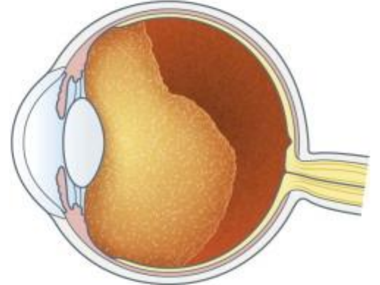 <p>Clinical Connection: <strong>Posterior Vitreous Detachment (PVD)</strong></p>