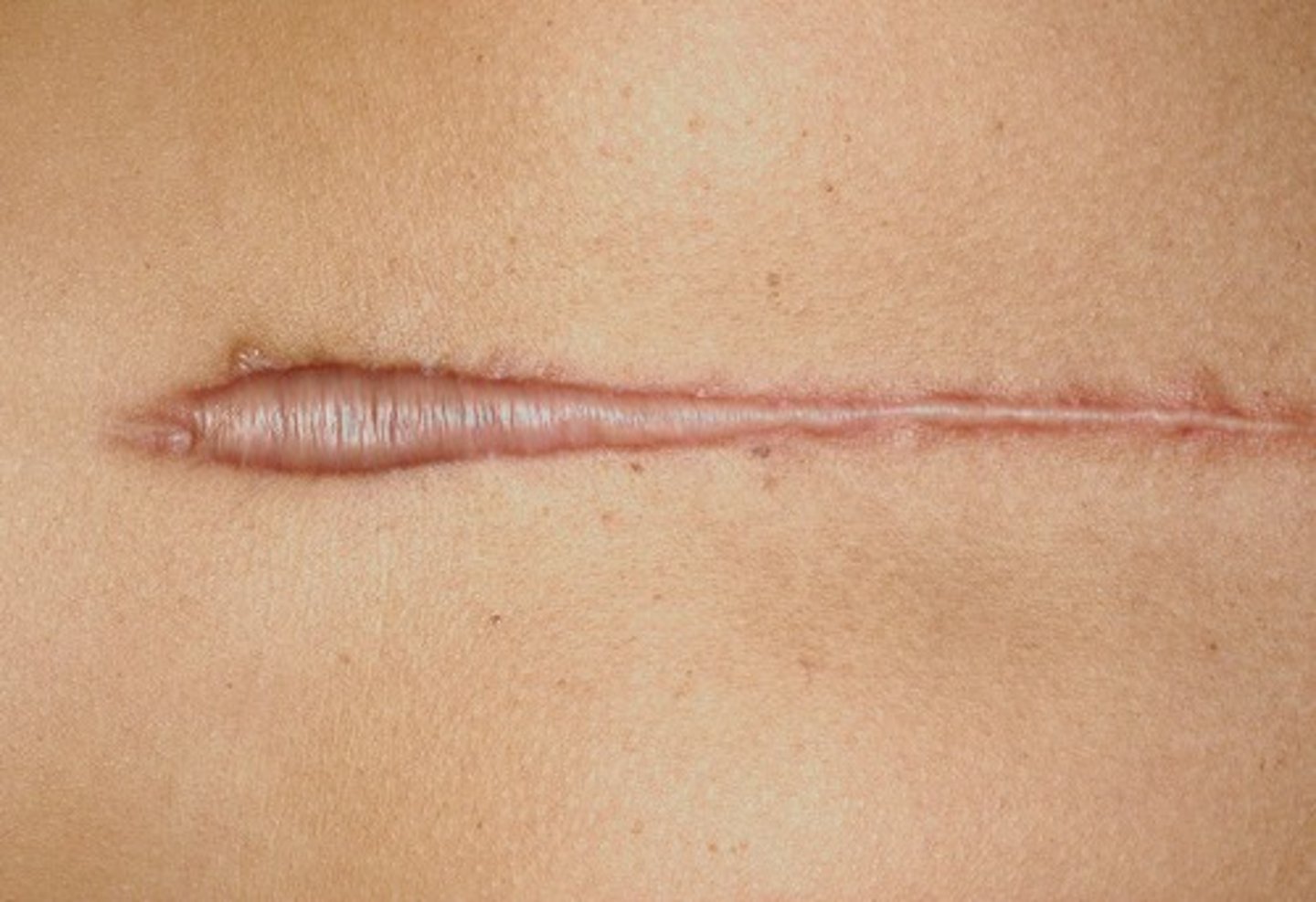 <p><b>Secondary</b> <br><br>flat connective tissue left after an injury or disease heals - can be red or purple initially but older scales may appear faded silver or white</p>