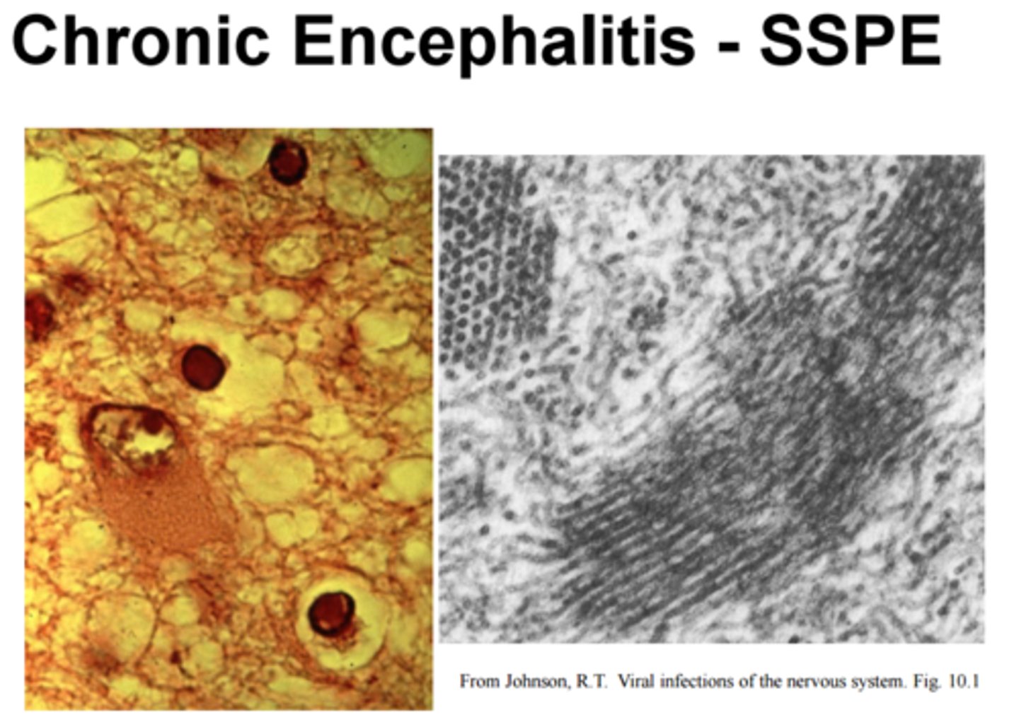 <p>Rare; occurs 1 to 10 years after measles recovery</p>