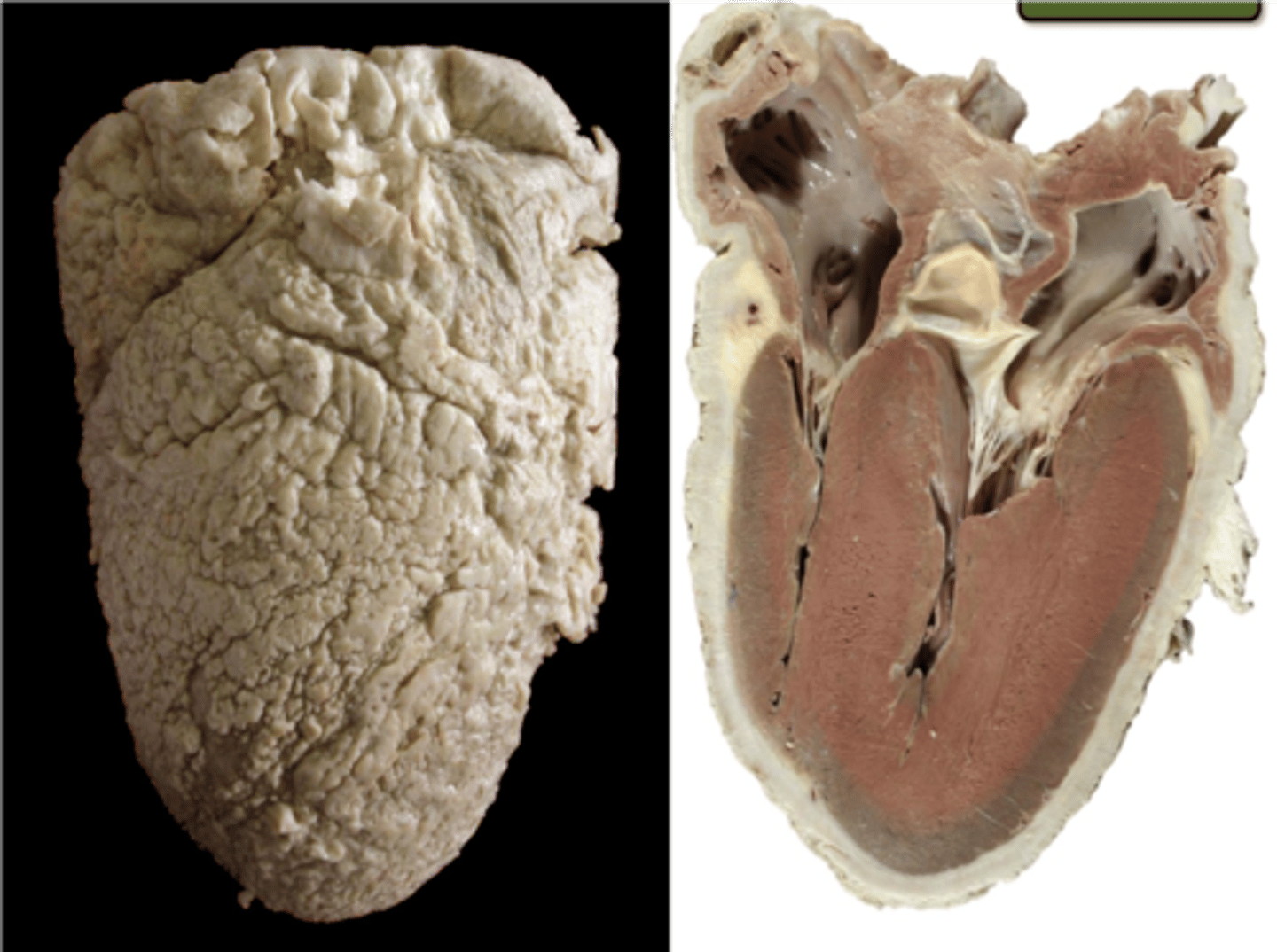 <p>A fibrous thickening of the pericardium that prevents adequate filling of the ventricles (diastolic dysfunction) and eventually results in cardiac failure</p>