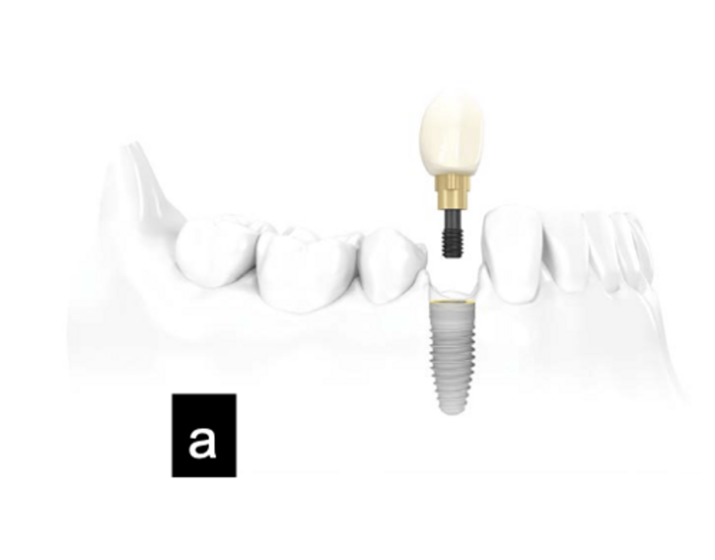 <p>What type of implant does this show?</p>