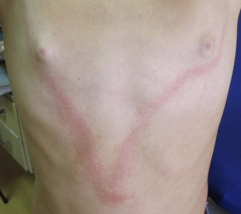 <ul><li><p>Inflammation of lymph vessels </p></li><li><p>Can occur after bacteremia </p></li></ul><p></p>