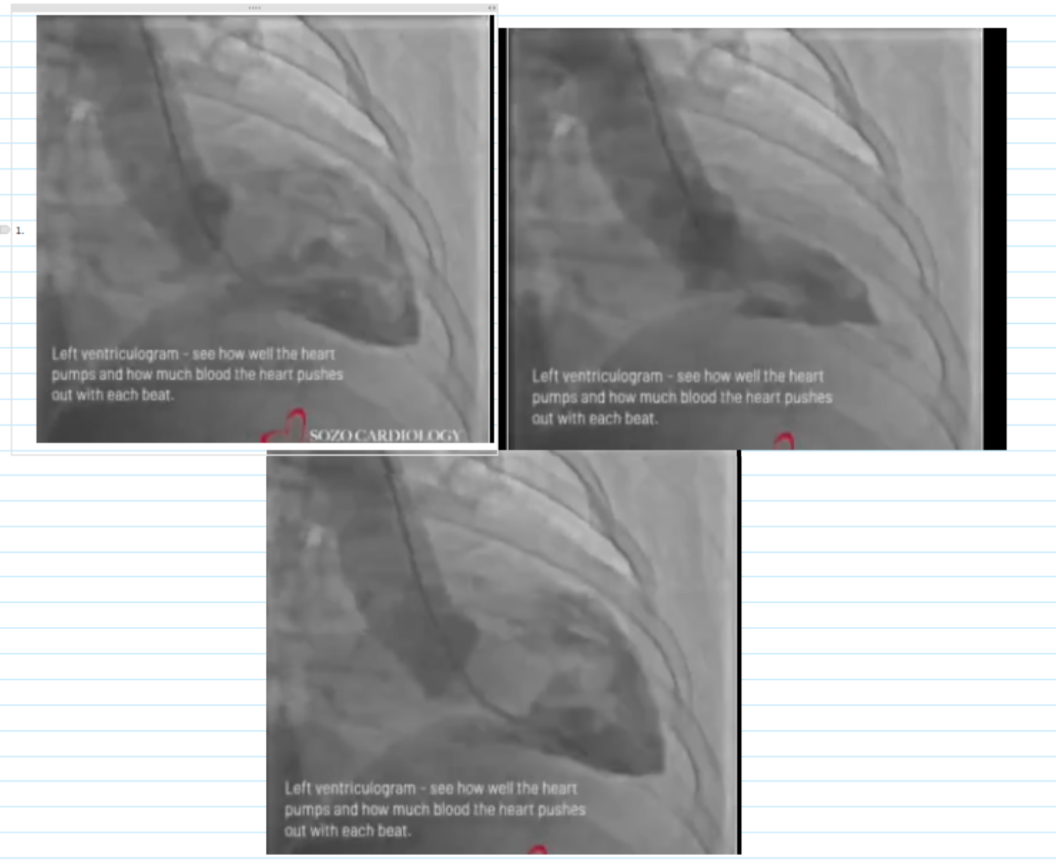 <p>WALL MOTION ASSESSMENT</p><p>ESTIMATED EF</p>