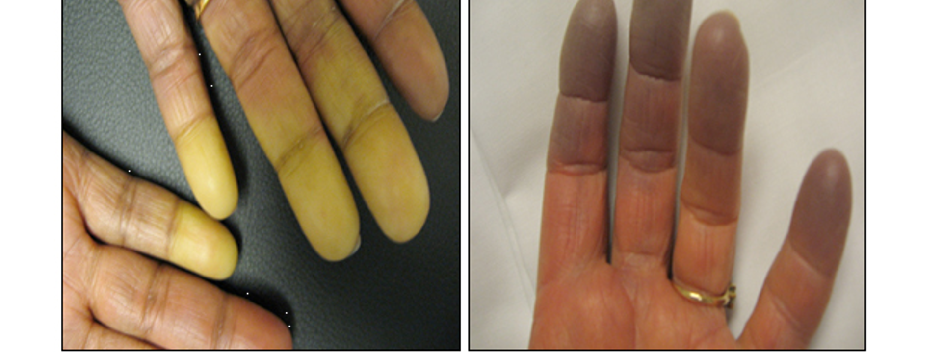 <p>exaggerated vascular response to cold temps or emotional stress</p>