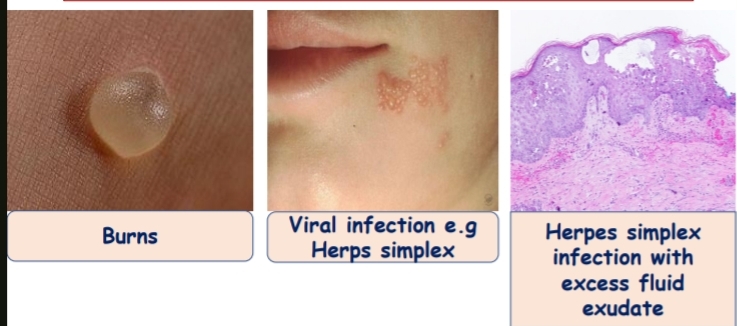 <p>Name of Inflammation: Serous inflammation</p><p>Characteristic Feature: Excess fluid exudation</p><p>Listed Causes: 1-Burns</p><p>2-Viral infection (e.g., Herpes simplex)</p><p></p><p>3⁦→Herpes simplex infection with excess fluid exudate</p>