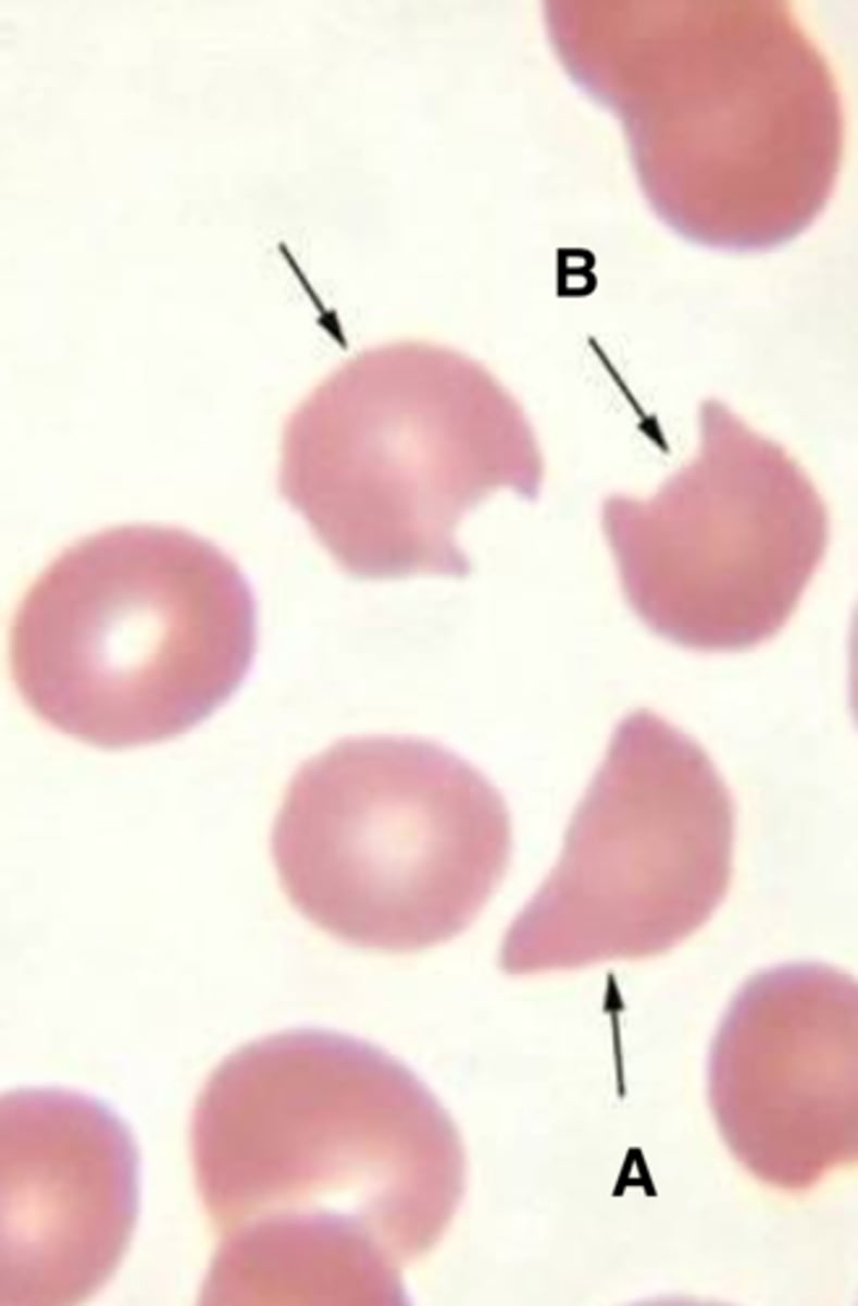 <p>heinz body (hgb remnants) removed by spleen</p><p>- thalassemia</p><p>- G6PD def</p>