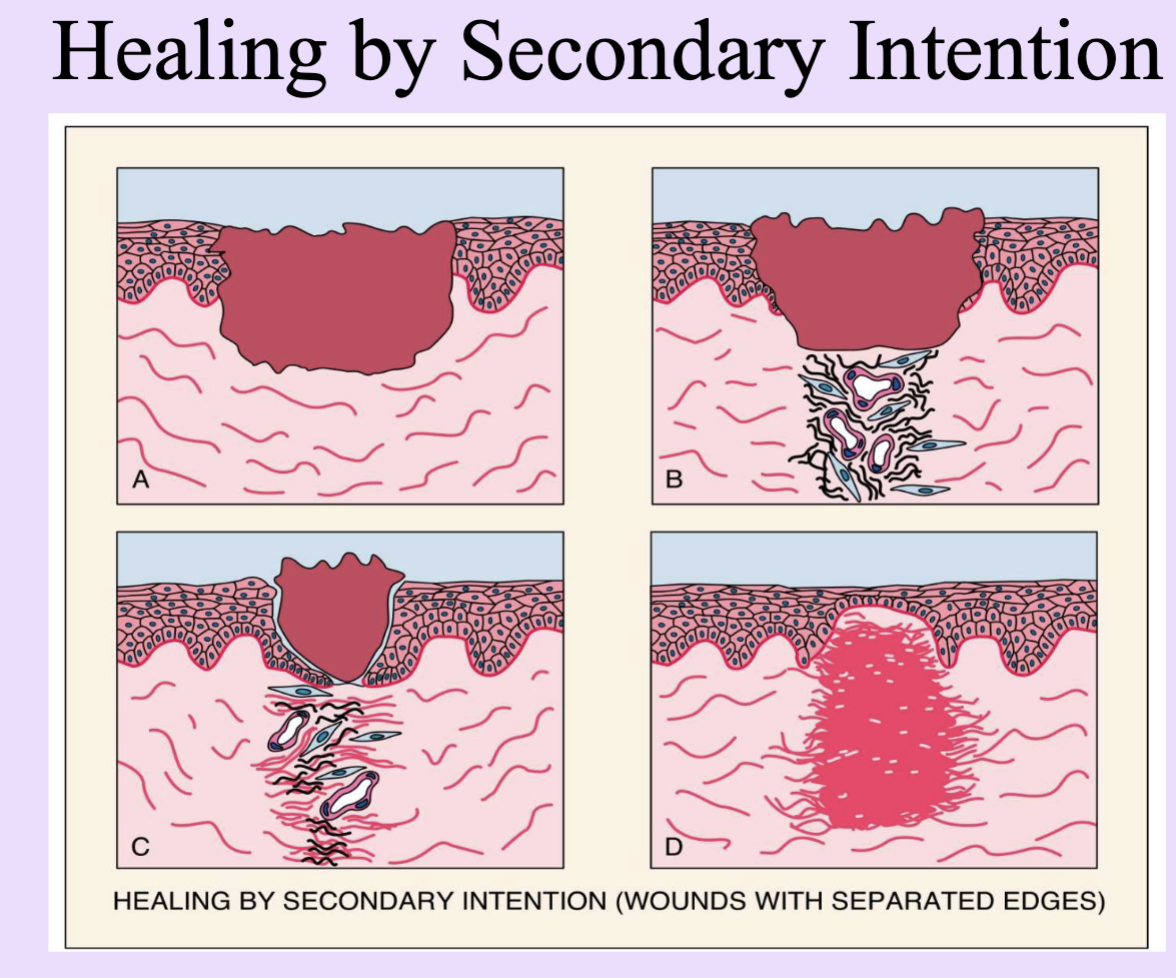 <p>Healing of large defects with separated edges; slower, more scar formation.</p><ul><li><p>nonsterile, infected wounds</p></li></ul><p></p>