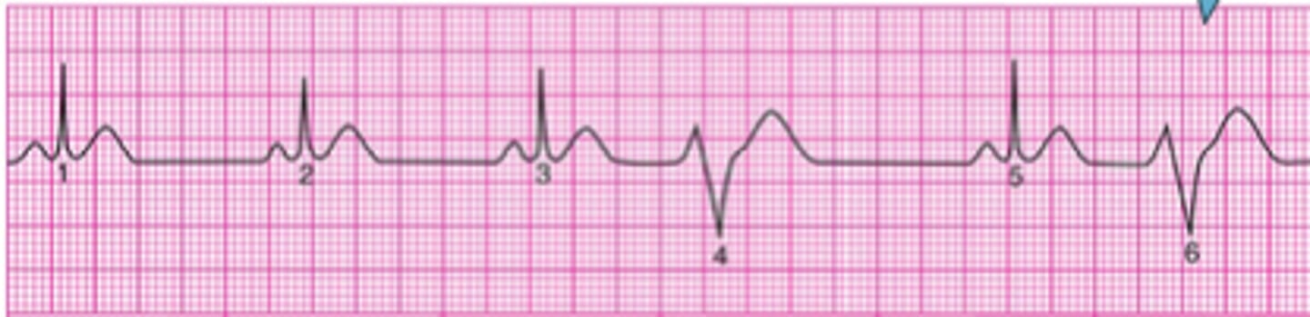 <p>- The QRS complex is wide, bizarre, and unlike the normal QRS complex Is not preceded by a P wave</p><p>- The regular heart rate is altered by a PVC. May be very irregular when there are many PVCs</p><p>- Common causes – Myocardial disease, hypoxemia, acidemia, hypokalemia, CHF. Also noted during theophylline, alpha stimulant and beta agonist toxicity. </p><p>- Treatment: oxygen, lidocaine</p>