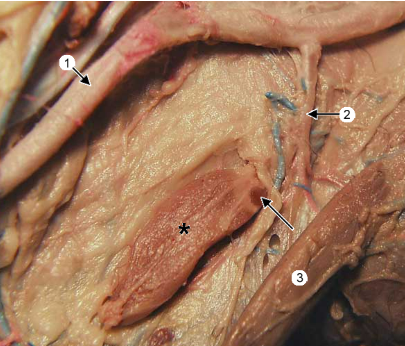 <p>this is an up close view of the common carotid artery (1). 3 is the sternothyroideus muscle. the head is to the right. </p><p>whats *</p>