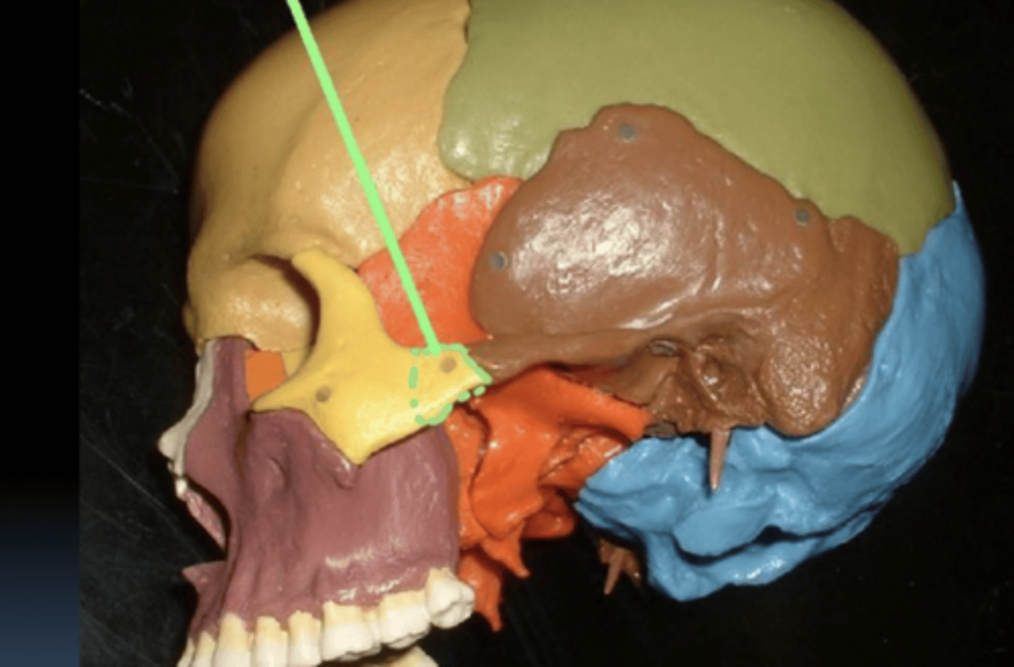 <p>temporal process of zygomatic bone</p>