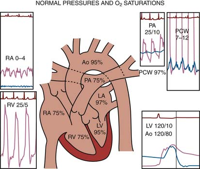 <p>Normal pulmonary artery pressures are characterized by a systolic range of <strong>(1) 20-40 mmHg</strong> and an end-diastolic range of (<strong>2) 8-12 </strong>mmHg.</p><p>25/10</p>