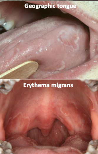 <p>Benign migratory glossitis; erythema migrans </p>