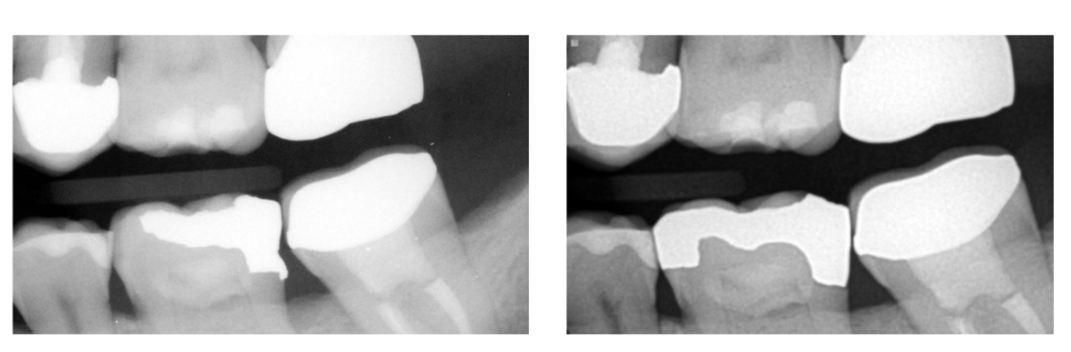<p>overhanging and defective</p>