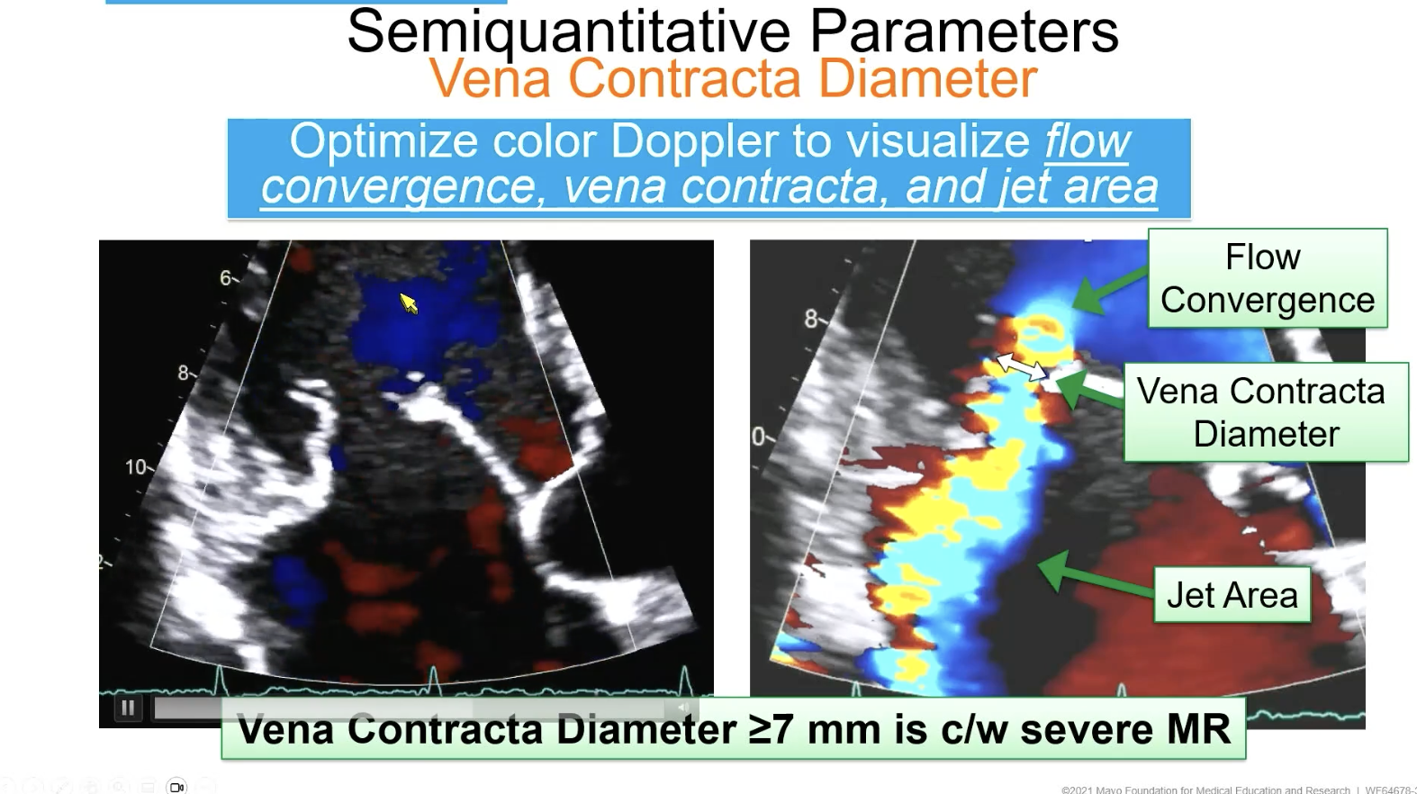 <p><u>> </u>7 mm</p><p></p>