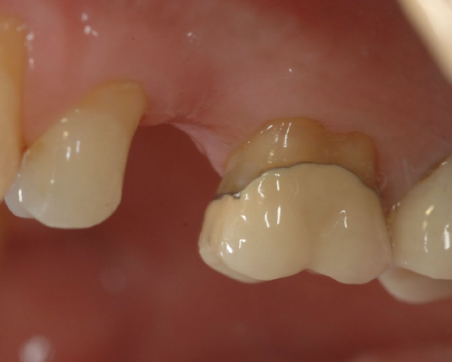 <p>What type of crown level would you suggestion for tooth #14?</p>