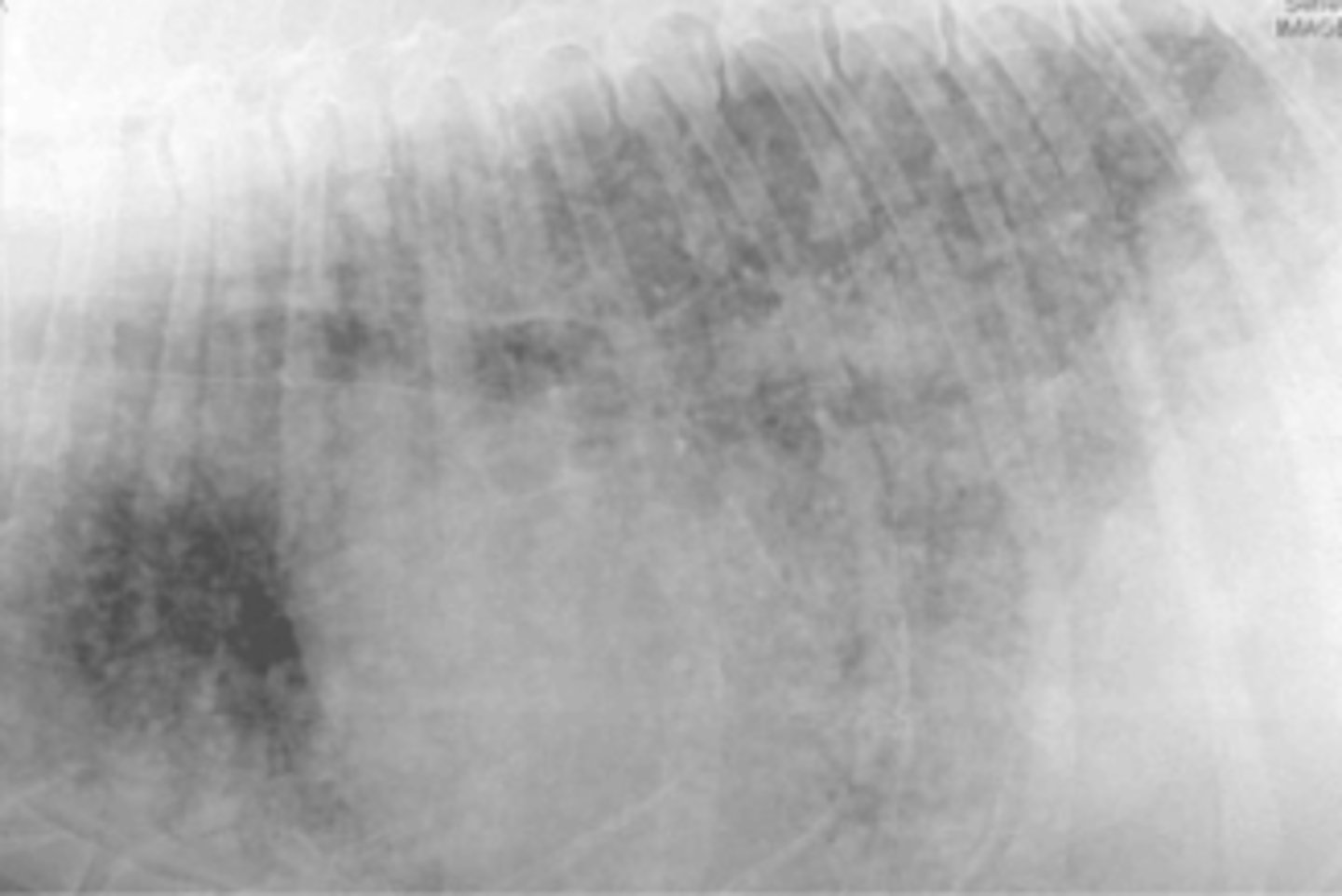 <p>What lung pattern is this?</p>