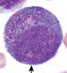 <p>Larger than the myeloblast. Nucleus is round to oval and is often central (chromatin clumping may be visible). Characteristic abundance of azurophilic primary granules. One to three nucleoli present but may be obscured by granules</p>