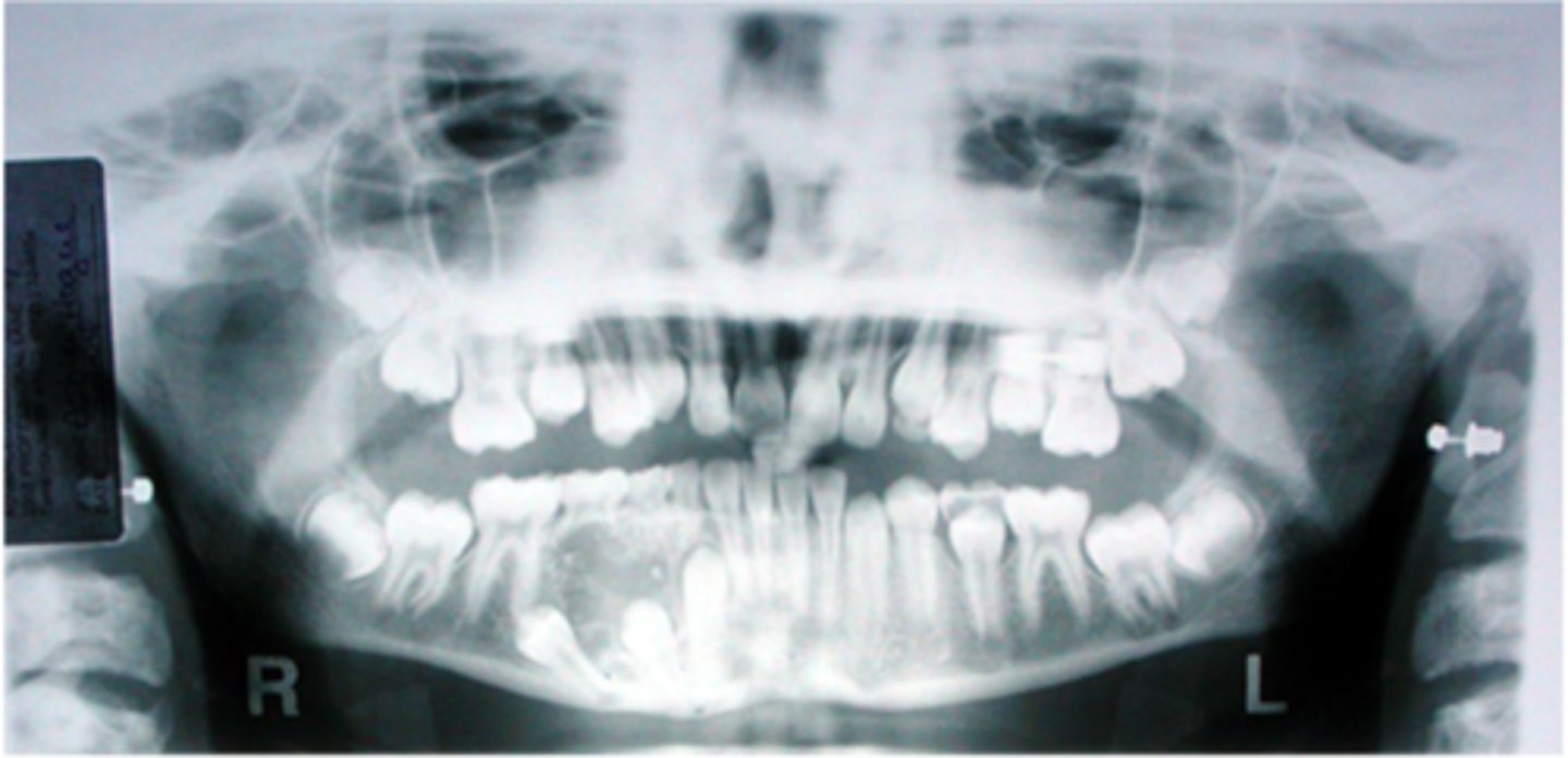 <p>This 11-year-old female presented with an asymptomatic swelling of the mandible. A panoramic radiograph was taken.</p><p>What are three diagnoses that you would include in the differential</p><p>diagnosis?</p>