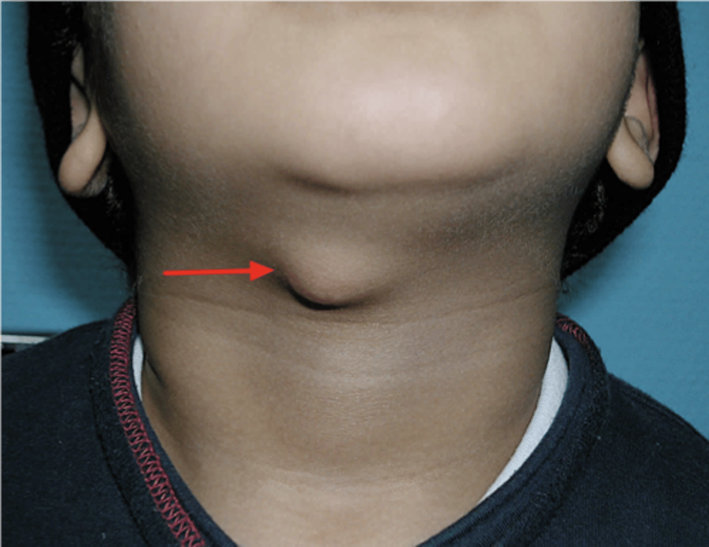 <p>thyroglossal tract cyst</p>
