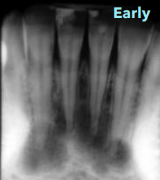 <p>radiolucent lesions </p>