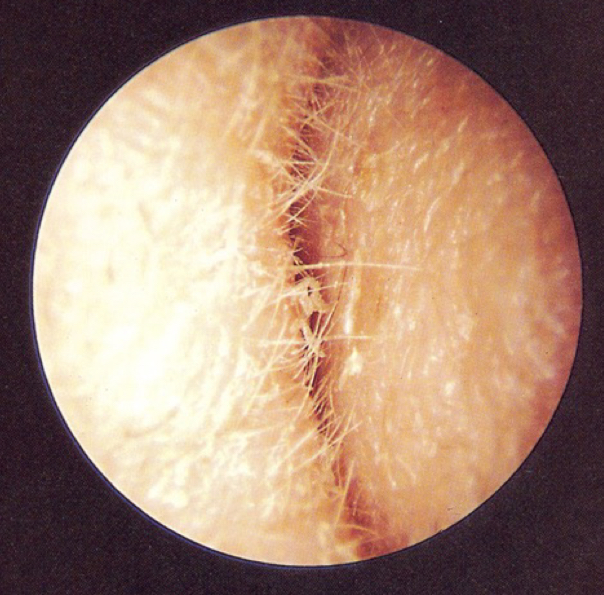 <p><u>disordered otoscopy: canal</u></p><p>collapsing ear canal</p>