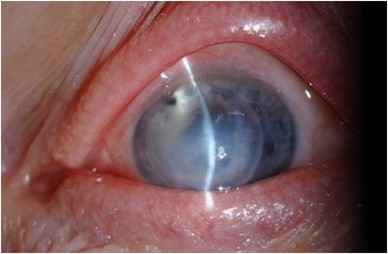 <ul><li><p><span style="color: blue"><strong><em><u>Corneal steepening becomes so great</u></em></strong></span><strong><em><u> that breaks occur in </u></em></strong><span style="color: red"><strong><em><u>Descemet’s Membrane</u></em></strong>&nbsp;</span></p></li><li><p><strong><u>Aqueous enters </u></strong><span style="color: green"><strong><u>corneal stroma + epithelium</u></strong></span> causing <span style="color: red"><strong>CORNEAL OEDEMA</strong></span></p></li><li><p><span style="color: red"><strong>MEN 2-3x affected</strong></span></p></li><li><p>Complication of KC</p></li><li><p>Eye rubbing</p></li><li><p>VKC</p></li></ul><p></p>