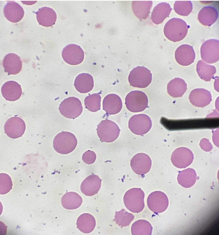 <p>A. Identify the pointed cell</p><p>B. Describe the striking feature</p><p>C. Associated with what condition?</p><p>D. Manifestations of the condition?</p><p>E. What Laboratory test detects the presence or absence of this cell in the blood?</p><p>F. Main membrane defect of the cell?</p>