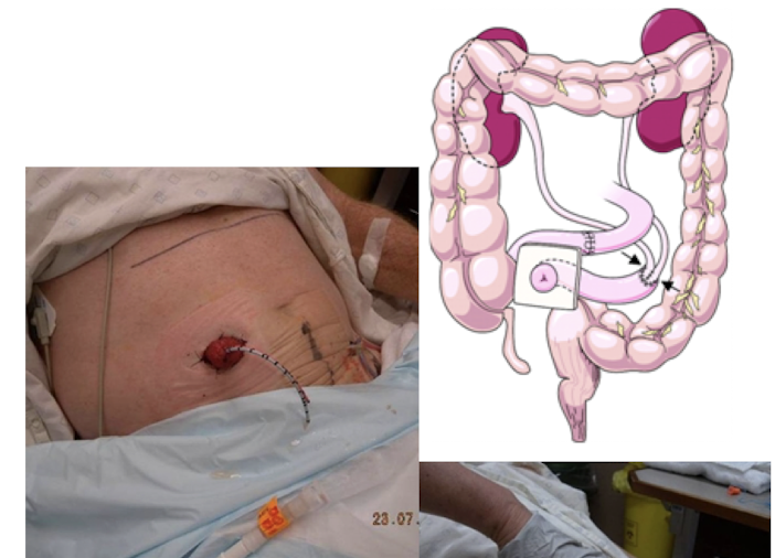 <p><strong>most common form of urinary diversion (urostomy), </strong>placed<strong> </strong>after cystectomy due to bladder cancer</p>