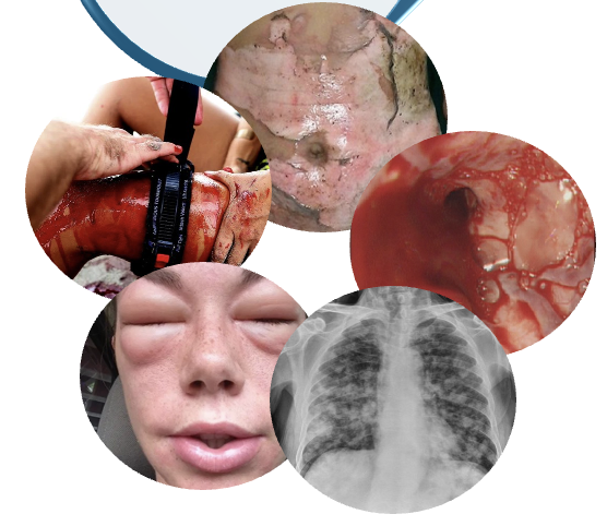 <ul><li><p>Infection</p></li><li><p>Trauma</p></li><li><p>Blood loss</p></li><li><p>Dehydration</p></li><li><p>Hyperthermia</p></li><li><p>Allergic reaction</p></li><li><p>Poisoning</p></li><li><p>SCI</p></li><li><p>MI</p></li><li><p>Burns</p></li></ul><p>Each of these can lead to decreased cardiac output of blood circulation and begin the cascade toward a shock state.</p><p></p>