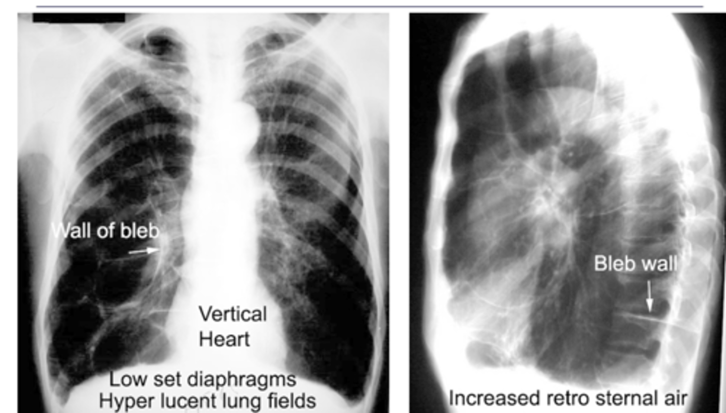<p>What dz are blebs and bullae associated with?</p>