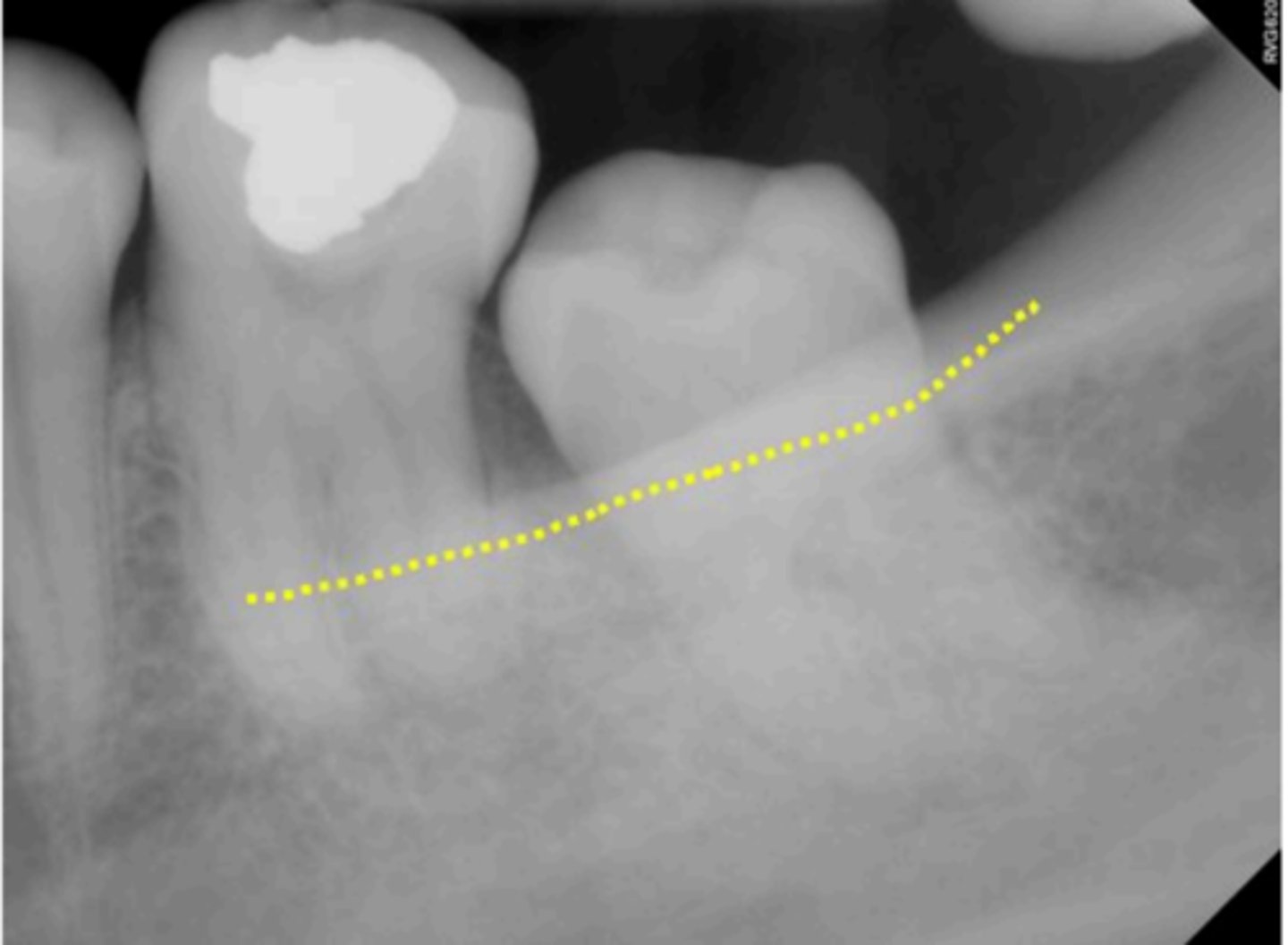 <p>What is indicated by the dotted line?</p>