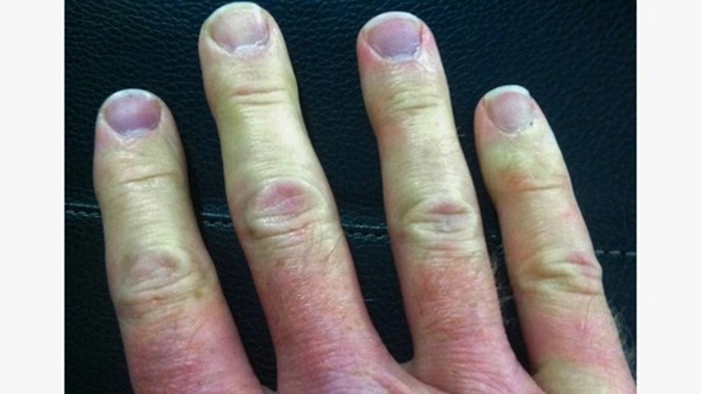 <p>The extremities of a patient become white or blanched in response to colder temperatures. If patients put their hands under water the extremities can turn red (aggravates it). It isn't always caused by rheumatoid arthritis, but it's a s/s.</p>
