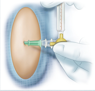 <ul><li><p>CT</p></li><li><p>MRI</p></li><li><p><span style="color: yellow"><strong>Lumbar puncture &amp; CSF analysis</strong></span>:</p><ul><li><p>Glucose, ↑WBCs, ↑ protein, pressure</p></li></ul></li><li><p>CBC</p></li><li><p>Urine, throat, nose, &amp; blood culture &amp; sensitivity</p></li></ul><div data-type="horizontalRule"><hr></div><p><span style="color: yellow"><strong>CT/MRI before LP</strong></span></p><ul><li><p>Rule out other conditions, especially those that may cause herniation from LP (altered LOC, papilledema, hx of CNS disease, being immunocompromised)</p></li><li><p>Specimen cultured and gram stained + blood culture</p></li><li><p>Gram staining → quick ID of causative bacteria à quickly starts on correct ABX therapy</p></li></ul><p><span style="color: yellow"><strong>CSF - assessment starts at appearance</strong></span></p><ul><li><p>Measure pressure with manometer (looks like a giant traditional glass thermometer)</p></li><li><p>Cloudy (bacterial) &amp; clear (viral)</p></li><li><p>↓ glucose (bacterial)</p></li><li><p>Collected before ABX!!!</p></li></ul><p><span style="color: yellow"><strong>Symptom driven</strong></span>: throat &amp; nose cultures less common (not definitive for meningitis)</p><p></p>