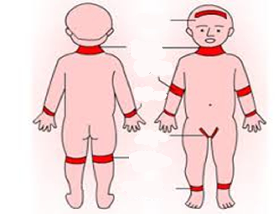 <p>What are the most common affected areas for atopic dermatitis in pediatric patients?</p>