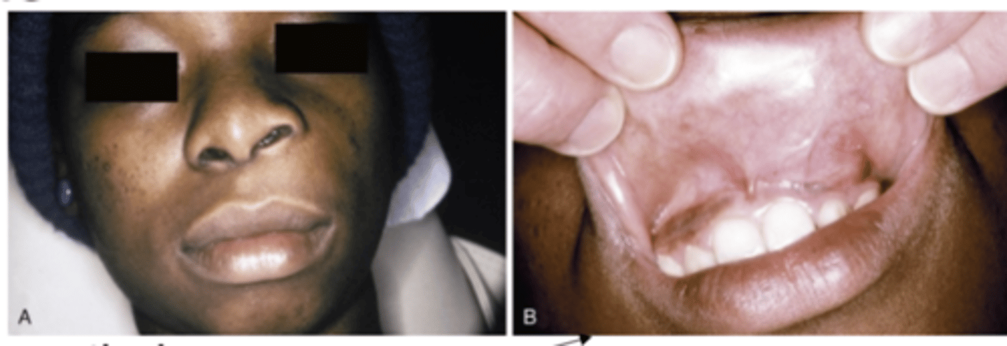 <p>What is the treatment of Nasolabial cyst? </p>
