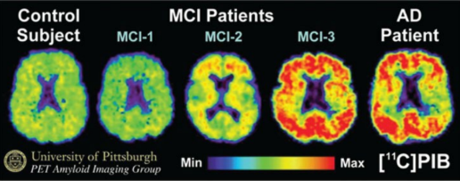 <p><strong>Diagnostic Imaging</strong></p><p>-Indicated in any patient with a ___, progressive cognitive complaint → brain imaging with MRI/CT ________ contrast </p><p>-PET with FDG → doesn’t confirm or exclude any _______ cause of dementia. May be useful in discriminating _________’_ disease vs frontotemporal dementia </p><p>-PET imaging with radiolabeled ligand for ____-_______ is highly sensitive to amyloid pathology. May provide positive evidence for Alzheimer disease in a patient with cognitive _______</p>