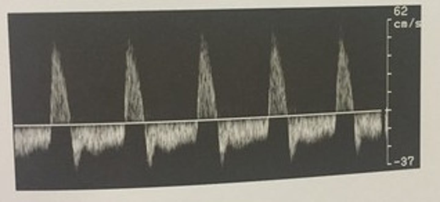 <p>426. (Peripheral arterial measurement techniques)</p><p>Which term can be used to describe this waveform?</p><p>a. monophasic</p><p>b. hepatofugal</p><p>c. bidirectional</p><p>d. tardus parvus</p>