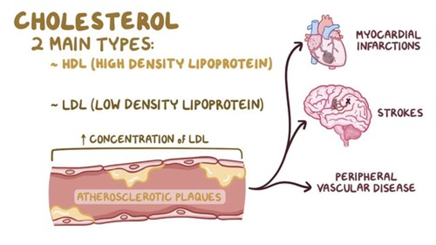 <p>Myocardial infarction (heart attack)</p><p>Caused by decreased or complete cessation of blood flow to a portion of the myocardium. (sometimes because atherosclerosis- build up of fat which can be caused by cholesterol)</p>