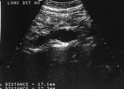 <p>a patient presents with a history of a pulsatile abdominal mass found on a physical exam. The sonogram of the distal abdominal aorta is most consistent with</p>