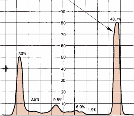 <p>Monoclonal Gammopathy</p>