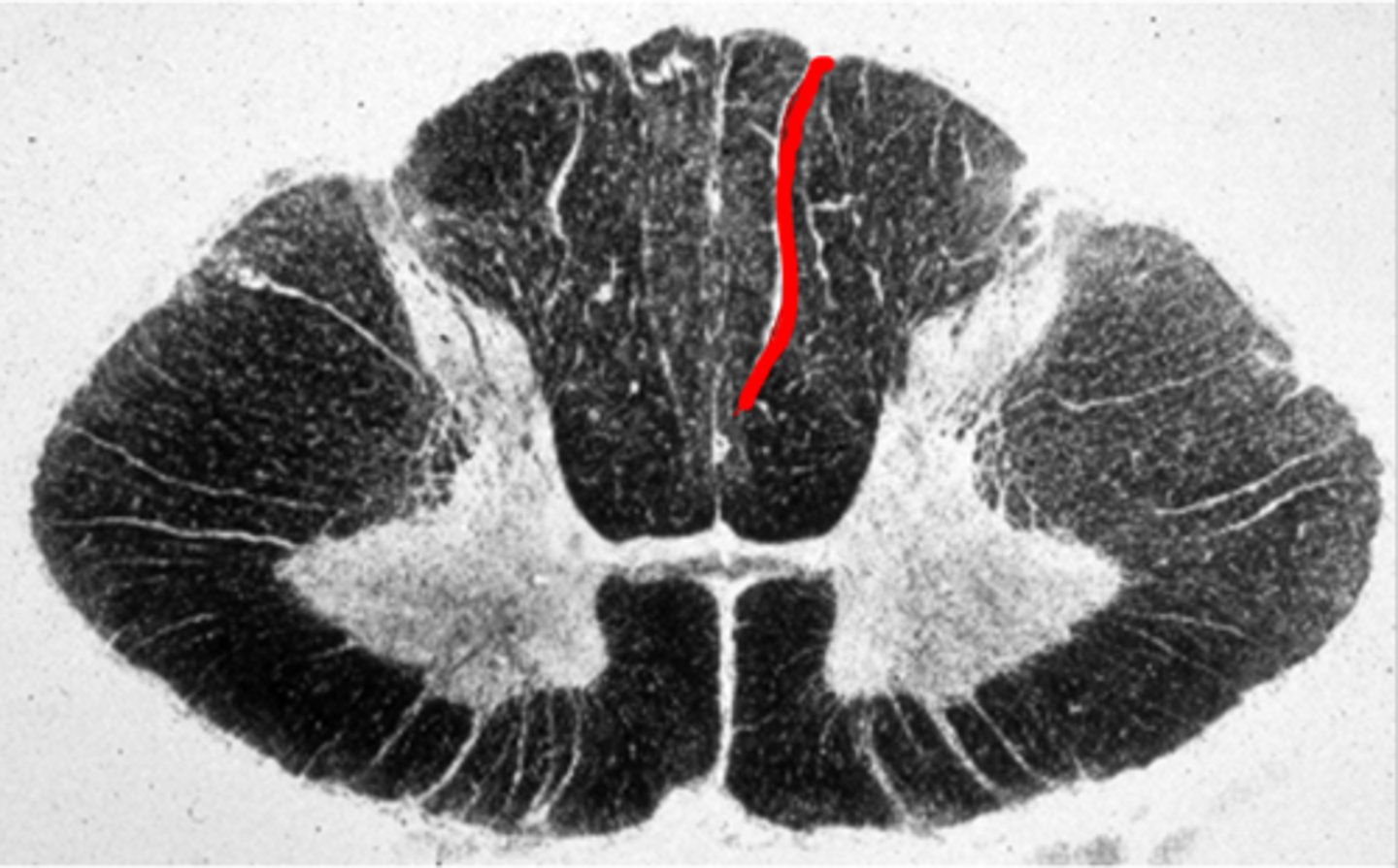 <p>Groove on the dorsal surface of the rostral part of the spinal cord, between the gracile and cuneate fasciculi, contains posterior spinal arteries</p>