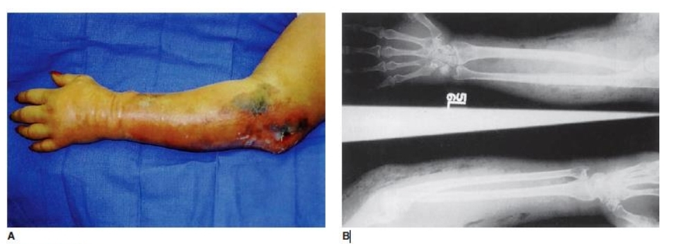 <p> Due to Clostridium perfringens</p>