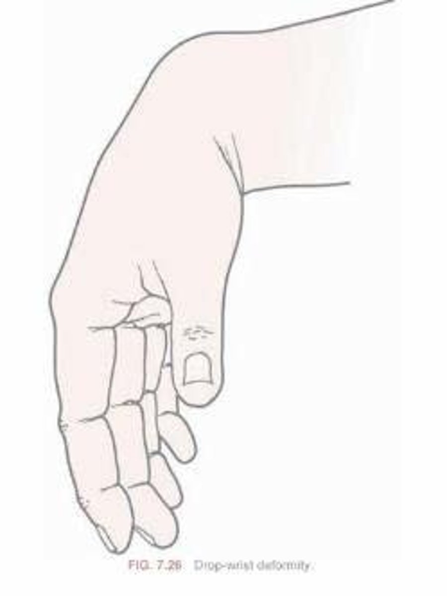 <p>paralyzed extensor of wrist due to radial nerve palsy.</p>
