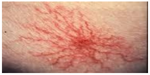 <p>- <strong><mark data-color="red" style="background-color: red; color: inherit">Central red arteriole surrounded by radial pattern of thin capillaries</mark></strong></p><p>- <strong><mark data-color="red" style="background-color: red; color: inherit">Raised oestrogen</mark></strong>—pregnant women, HRT, OCP</p><p>- Hepatic disease—<strong><mark data-color="purple" style="background-color: purple; color: inherit">failure to metabolise oestrogen </mark></strong></p>