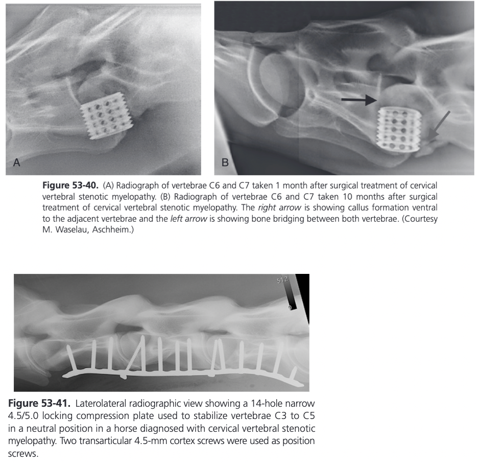 <ul><li><p><span>Uses a threaded or partially threaded titanium Kerf-cut cylinder (KCC), which has multiple holes and is open ended</span></p><ul><li><p><span>Leaves an isthmus of bone in the center of the cylinder, the aim being to encourage faster fusion by increasing the blood supply to the graft material and to reduce the incidence of postoperative fracture and implant migration</span></p></li></ul></li><li><p><span>Another technique using a ventral LCP has been described</span></p><ul><li><p><span>Ventral fusion under fluoroscopic control may involve two or three cervical vertebrae</span></p></li><li><p><span>A narrow or broad 4.5/5.0 LCP is contoured to the ventral aspect of the CV</span></p></li><li><p><span>Most plate holes are filled with 5.0 LHSs</span></p></li><li><p><span>Either 4.5 or 5.5 mm cortex screws are inserted if nonperpendicular angulation is necessary</span></p></li></ul></li><li><p><span>A recent in vitro study indicated that a LCP is biomechanically superior to the KCC-technique for this indication (Reardon et al, 2009)</span></p></li></ul>